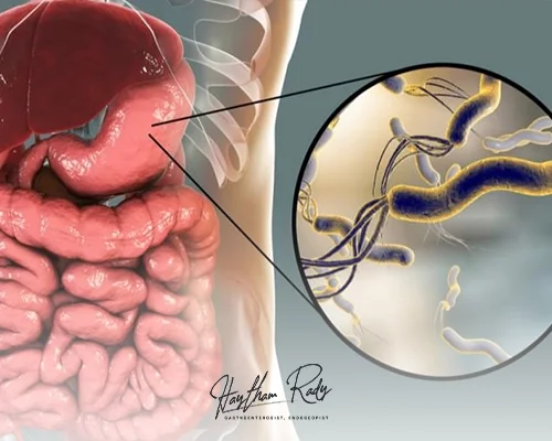 Is it possible to get rid of stomach bacteria permanently?