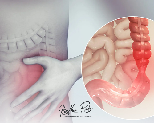 Colon diseases