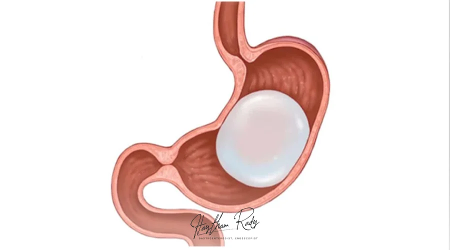 تجربتي مع بالون المعدة